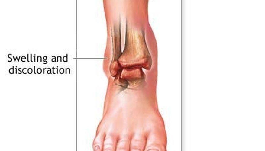 Anatomy of an ankle sprain Anatomy of an ankle sprain