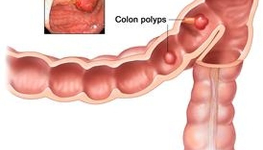 Polyps Polyps