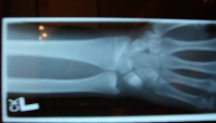 Photo Credit: x-ray of arm image by Tammy Mobley from <a href='http://www.fotolia.com'>Fotolia.com</a> X-ray image of the forearm