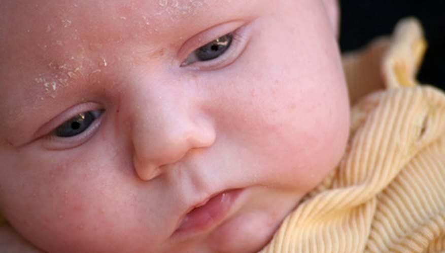 Dry skin affects infants, too. Dry skin affects infants, too.