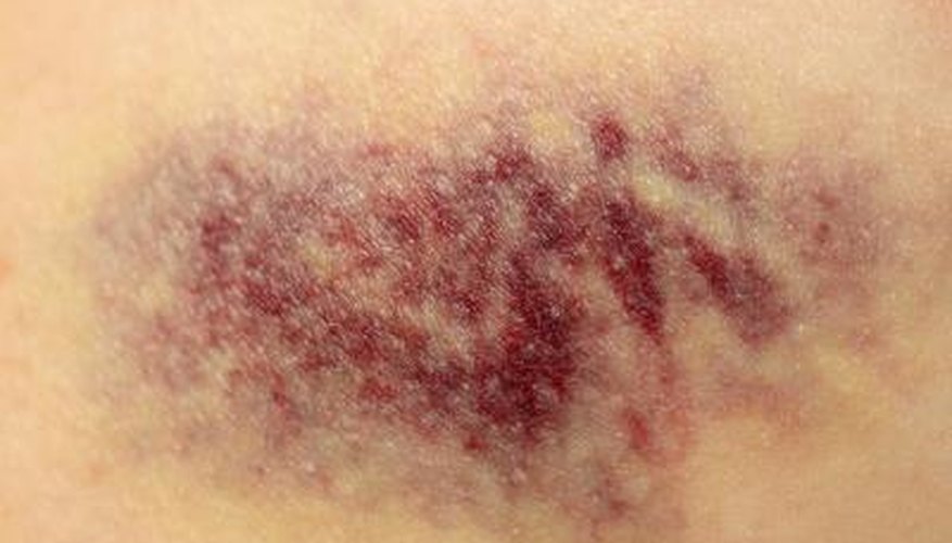 Rub the gel on bruise. Rub the gel on bruise.