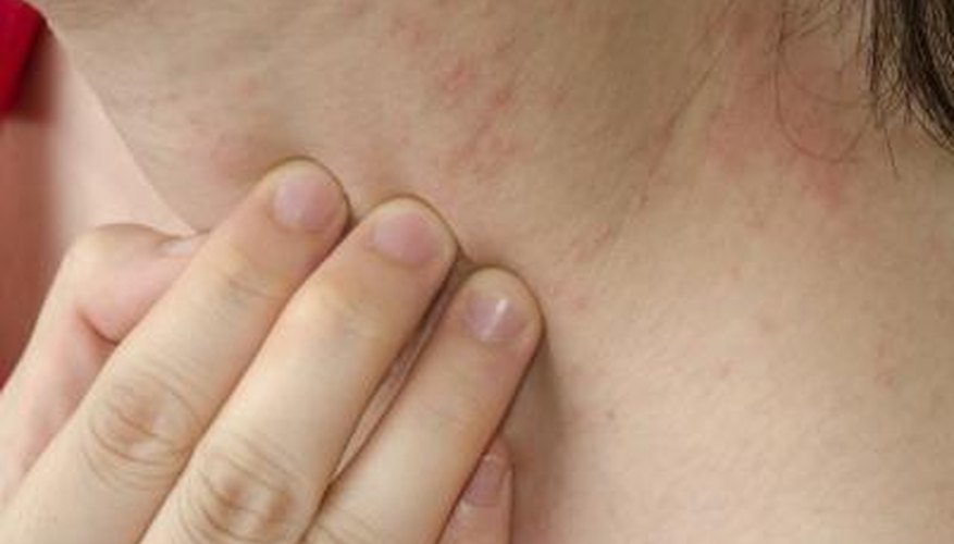 Scientists first discovered the human itch mite in the 17th century. Scientists first discovered the human itch mite in the 17th century.