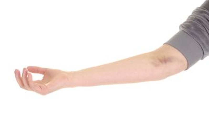 Bruise on arm. Bruise on arm.