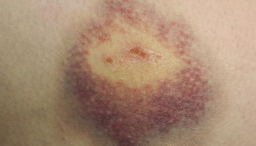 Reapply until the bruise fades. Reapply until the bruise fades.