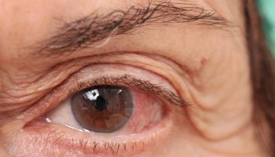 Pink eye. Pink eye.