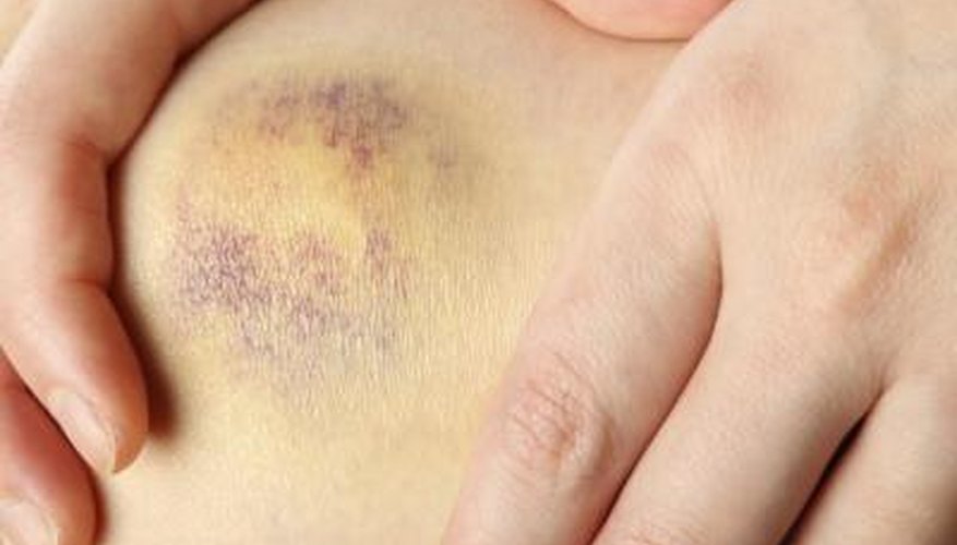 Apply pressure to wound and keep ice pack on for 20 minutes,\. Apply pressure to wound and keep ice pack on for 20 minutes,\.