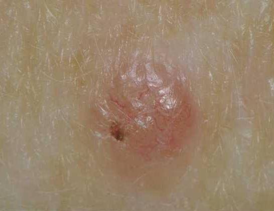 How Does Skin Cancer Start