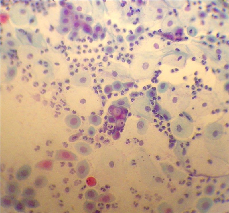 Do Pap Smears Detect Chlamydia?