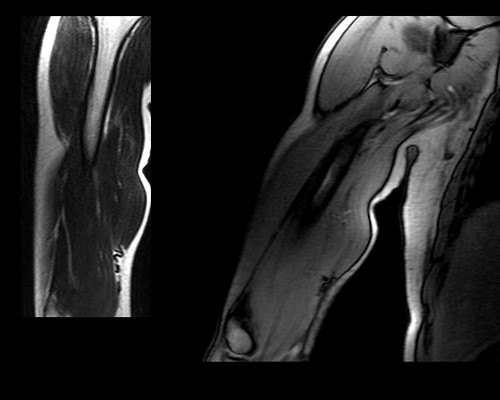 the-average-cost-of-knee-replacement-surgery