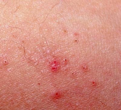 The Best Scabies Treatment (with Pictures) | eHow