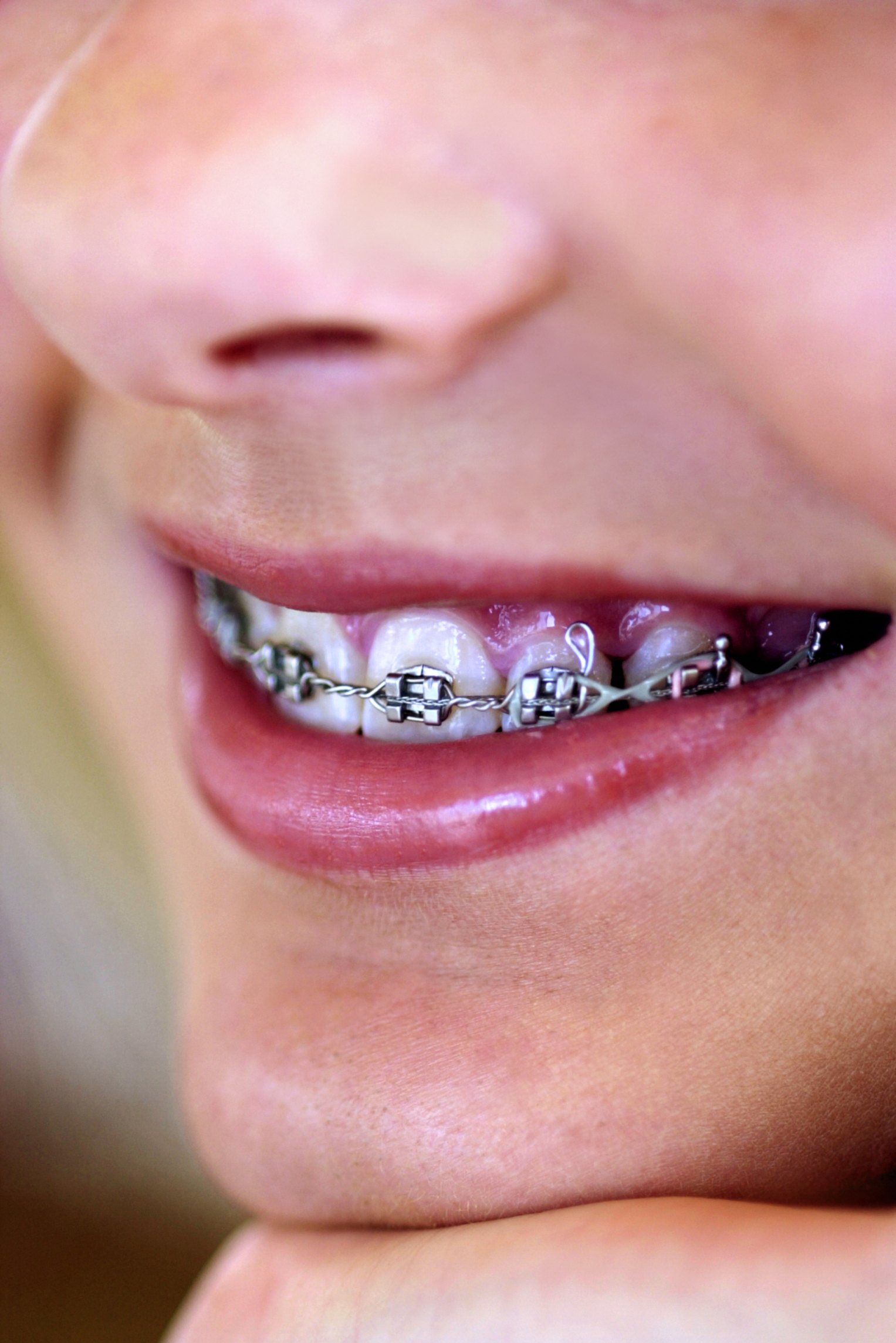 How to Make Brackets for Fake Braces | eHow
